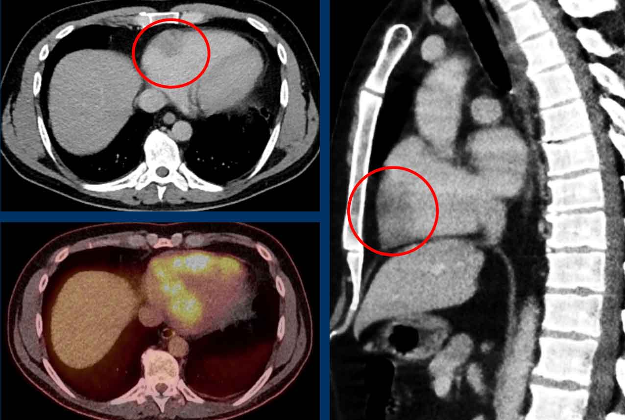 Cardiac lymphoma