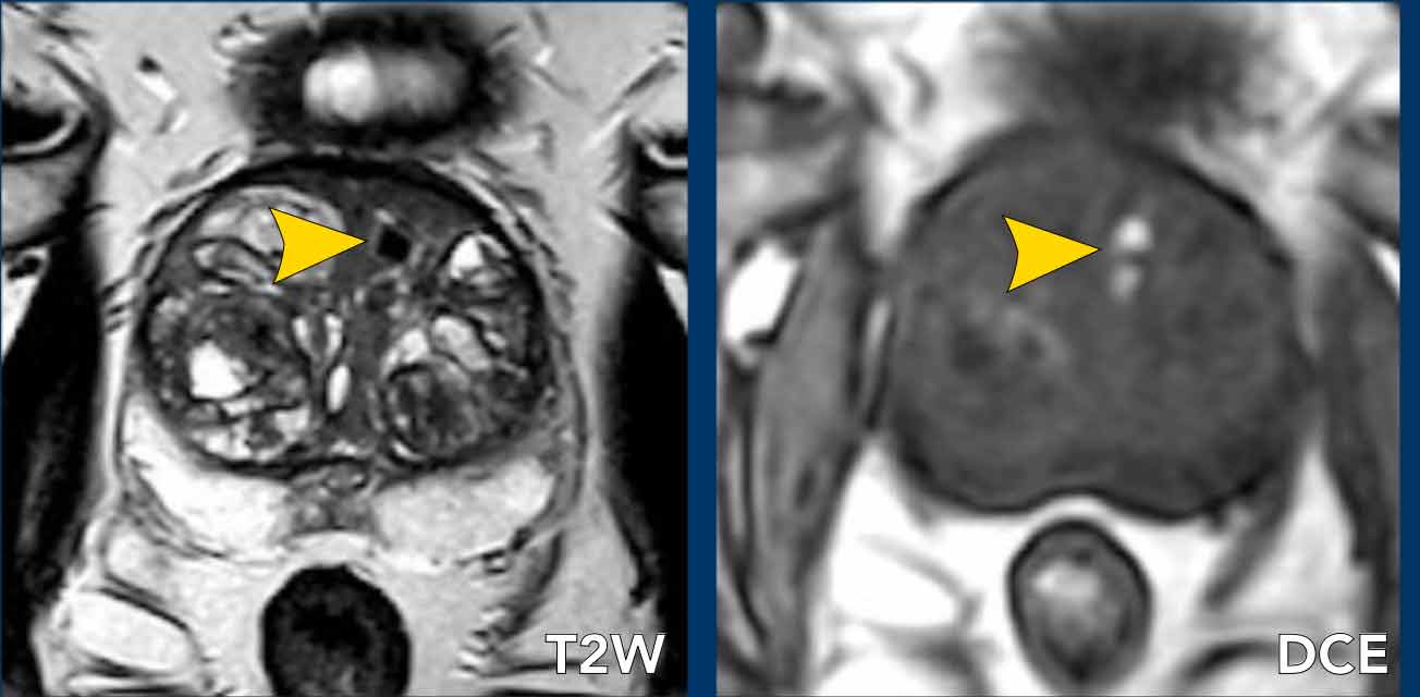 Hemorrhage. The DCE image is prior to contrast enhancement.