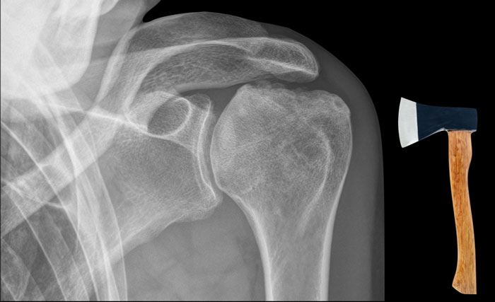 Hatchet lesion. Ankylosing spondylitis of the humeral head