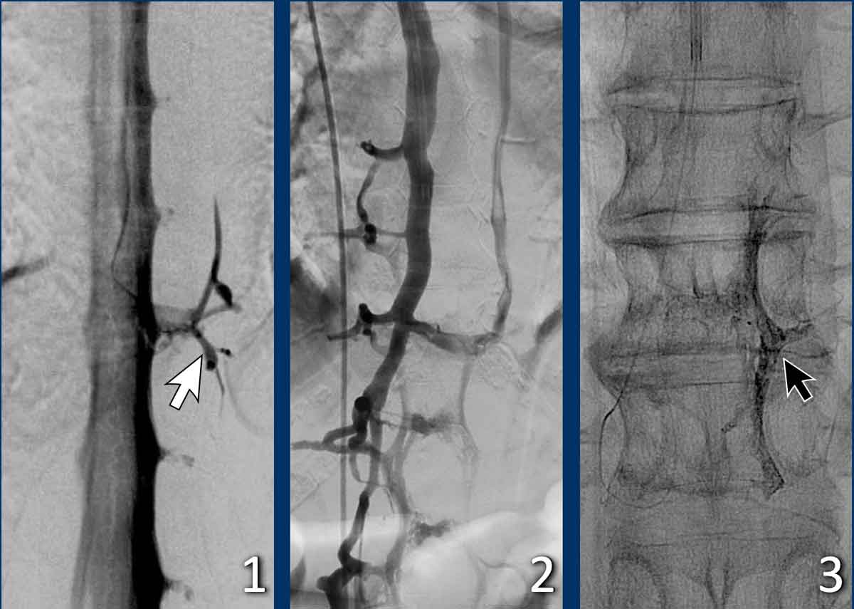 Treatment of a CSF-venous fistula through a venous route. Courtesy René van den Berg and Olvert Berkhemer