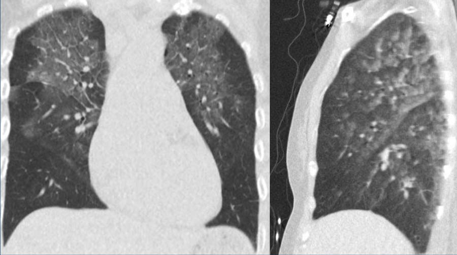 Gravity dependent groundglass with interlobular thickening in cardiogenic edema.