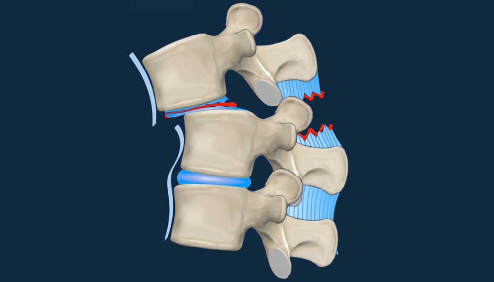 AO Spine Classification of Thoracolumbar Fractures