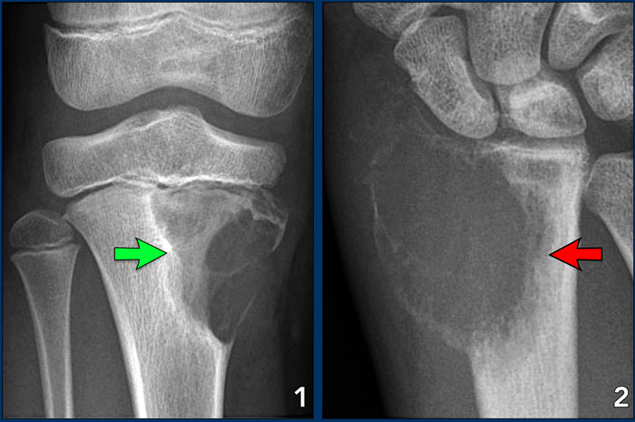 Chondromyxoid fibroma (left), Giant cell tumor (right)