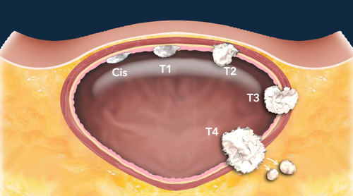 Bladder Cancer - VI-RADS