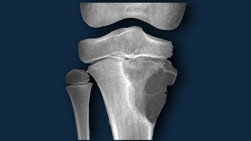 Bone tumors - Differential diagnosis