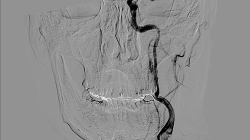 How to Differentiate Carotid Obstructions