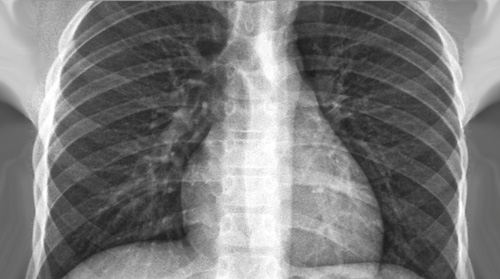 Chest X-Ray - Basic Interpretation