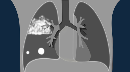 Chest X-Ray - Lung disease