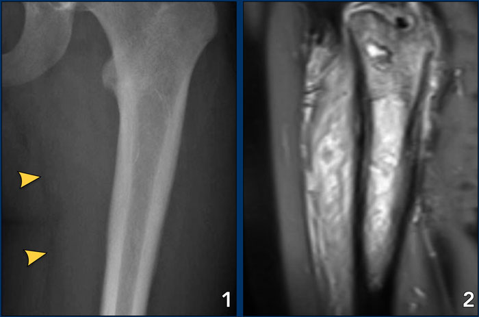 Ewing's sarcoma with permeative growth through the haversian channels accompanied by a large soft tissue mass