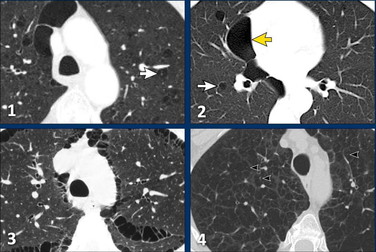 Examples of emphysema and a case of BHD