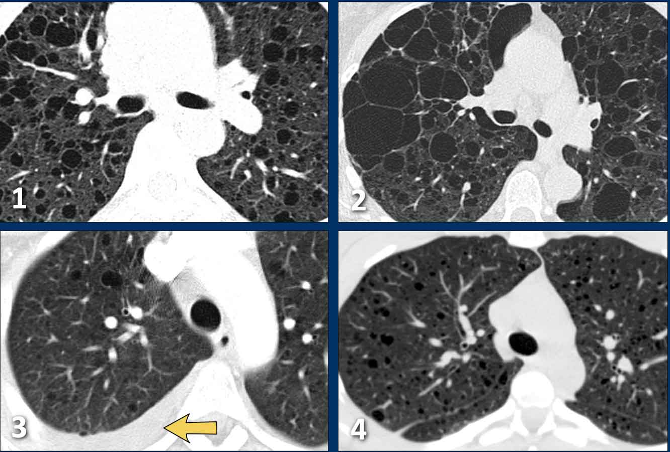 Examples of Lymphangioleiomyomatosis