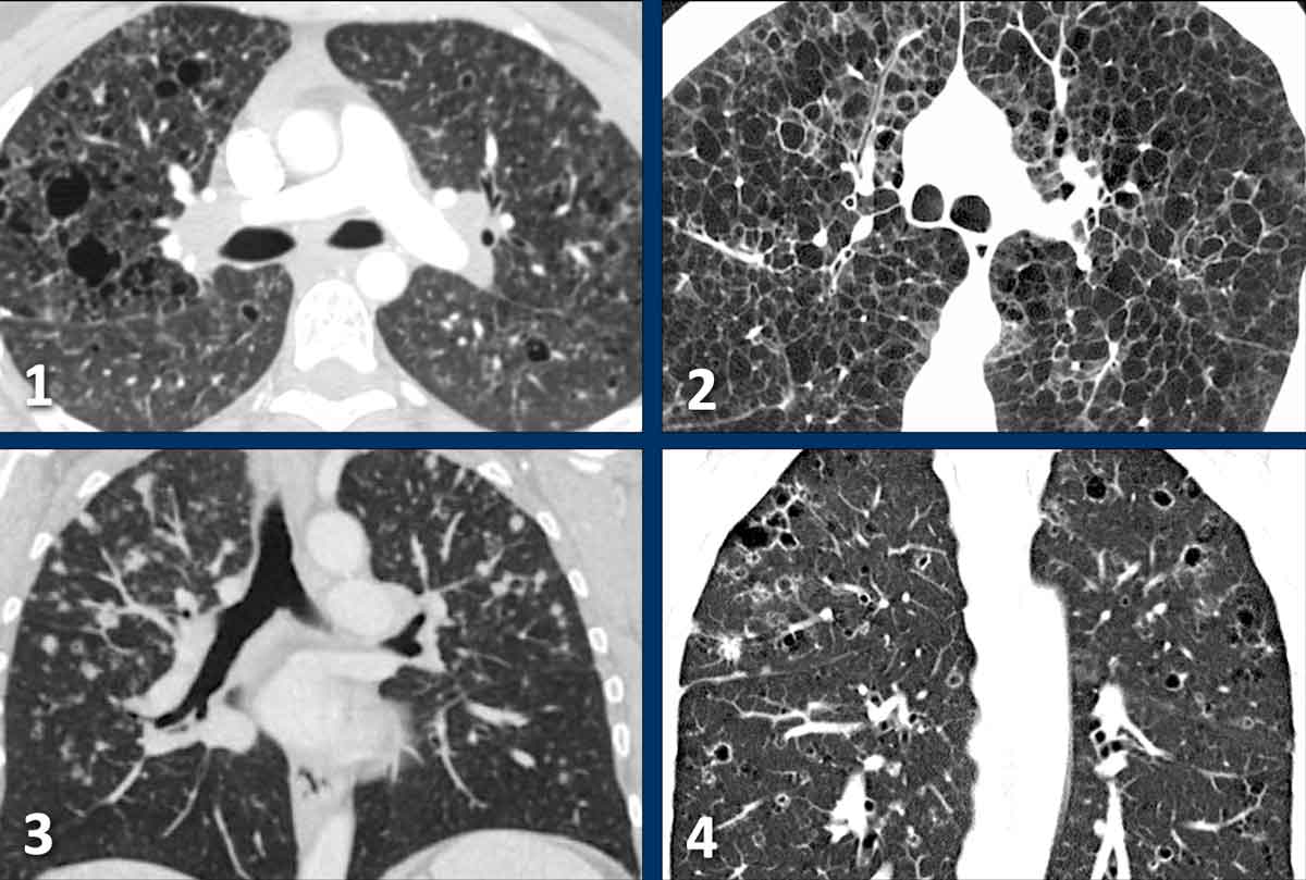 Examples of Langerhans Cell Histiocytosis