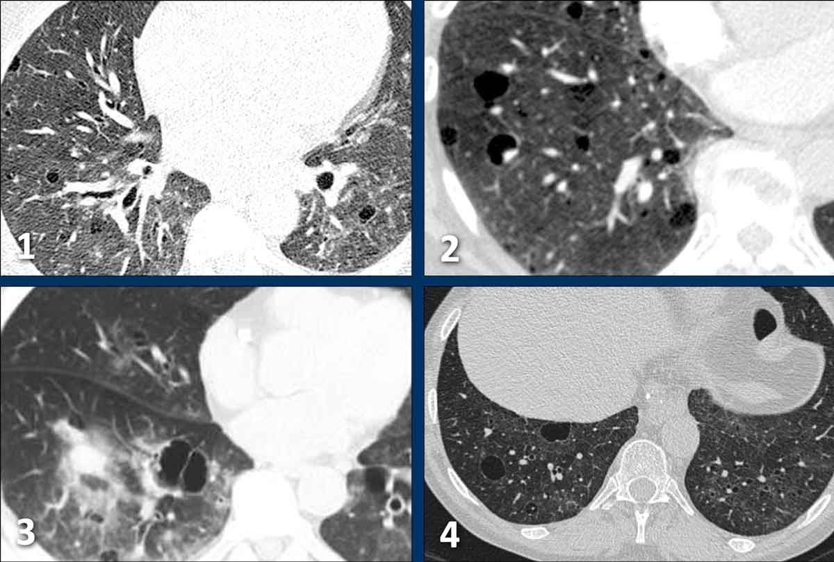 Examples of Lymphoid interstitial pneumonia