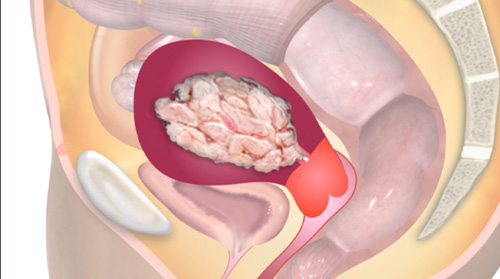 Endometrial Cancer - MR staging