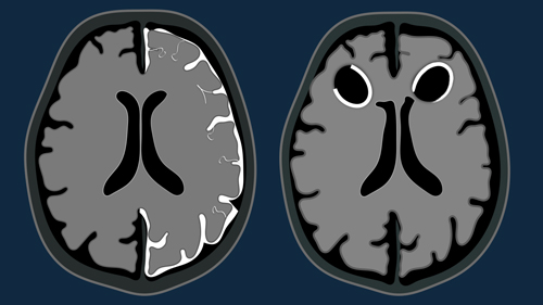 Enhancement Patterns in CNS disease