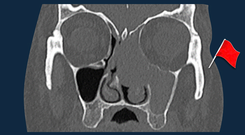 Head Neck tumors - When to think of malignancy