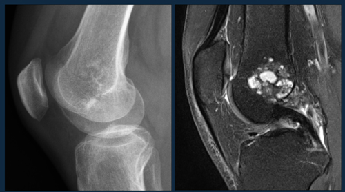 Cartilage tumors