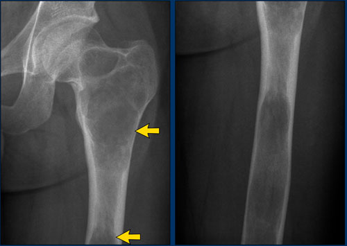 LEFT: Polyostotic Fibrous Dysplasia. RIGHT: Multiple osteolytic lesions in femurshaft