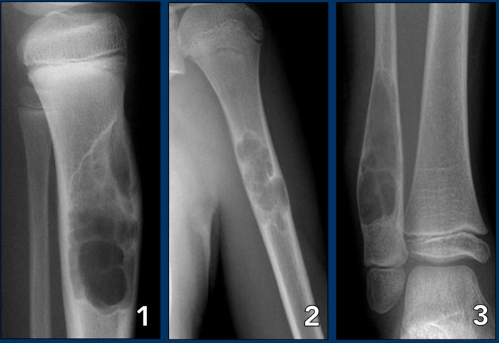 Narrow zone of transition: NOF, SBC and ABC