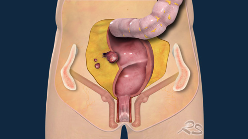 Rectal Cancer  MR staging 3.0