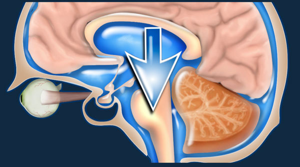 Spontaneous Intracranial Hypotension