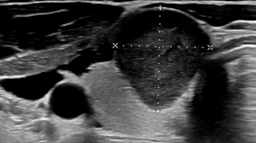 TI-RADS - Thyroid Imaging Reporting and Data System