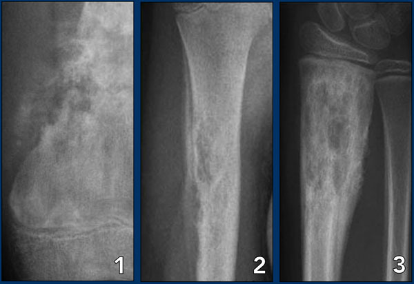 Wide zone of transition indicates malignancy or infection or eosinophilic granuloma