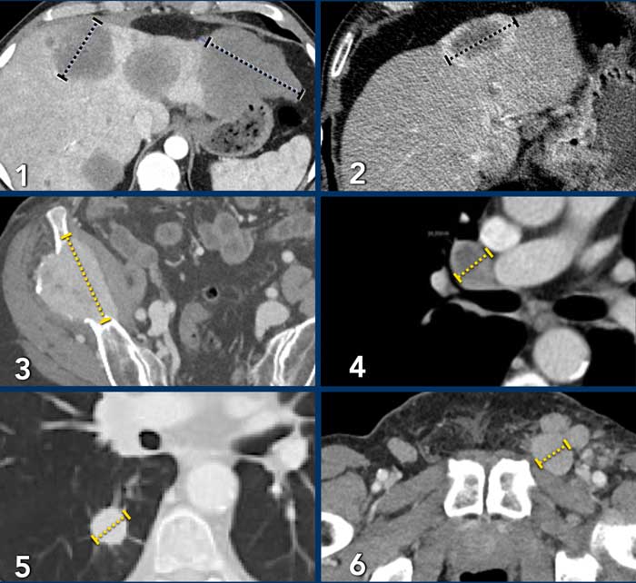 Examples of target lesions