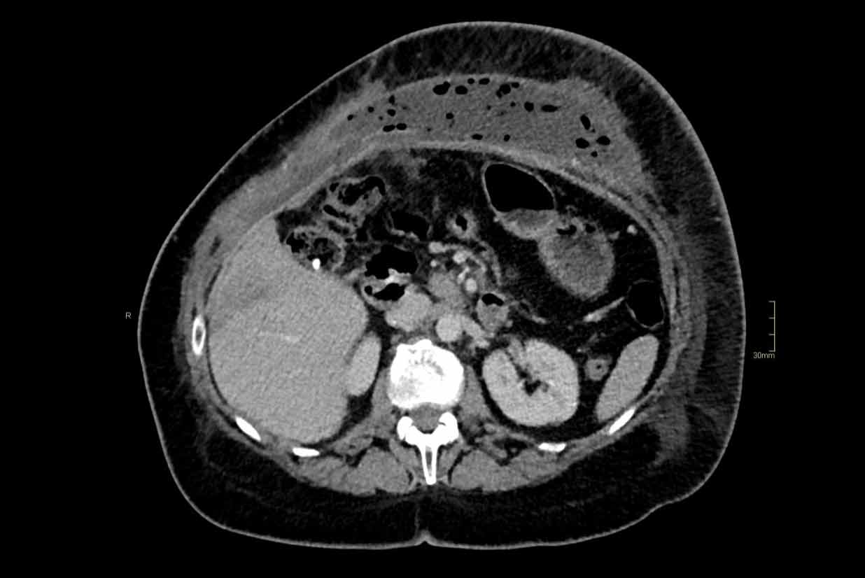 Abdominal wall abscess