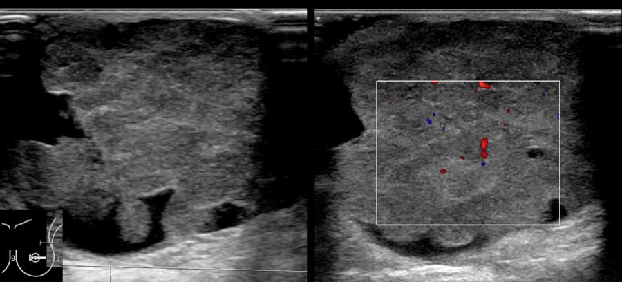 Intracystic breast cancer