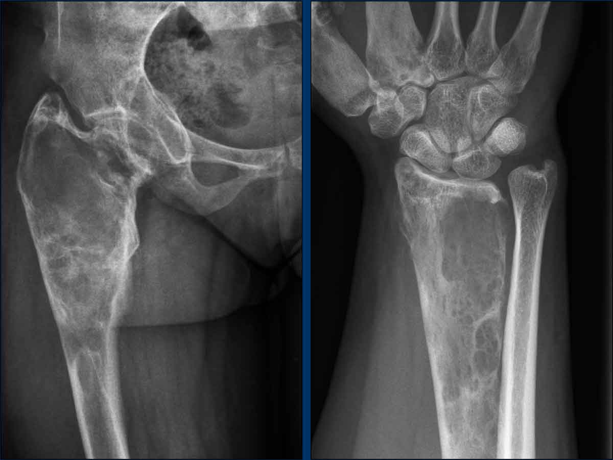 Polyostotic fibrous dysplasia