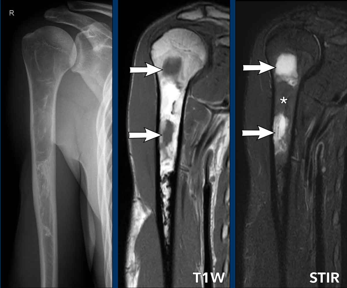 Fibrous dysplasia