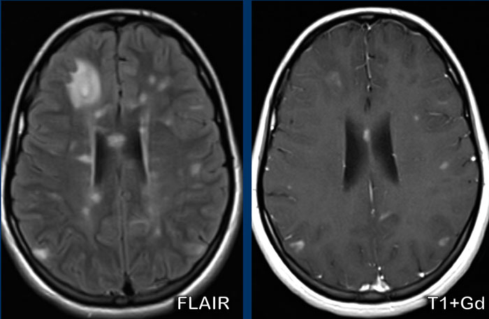 Mutiple Sclerosis