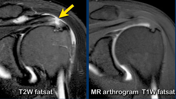 Bursal-sided tear not visible on MR arthrogram.