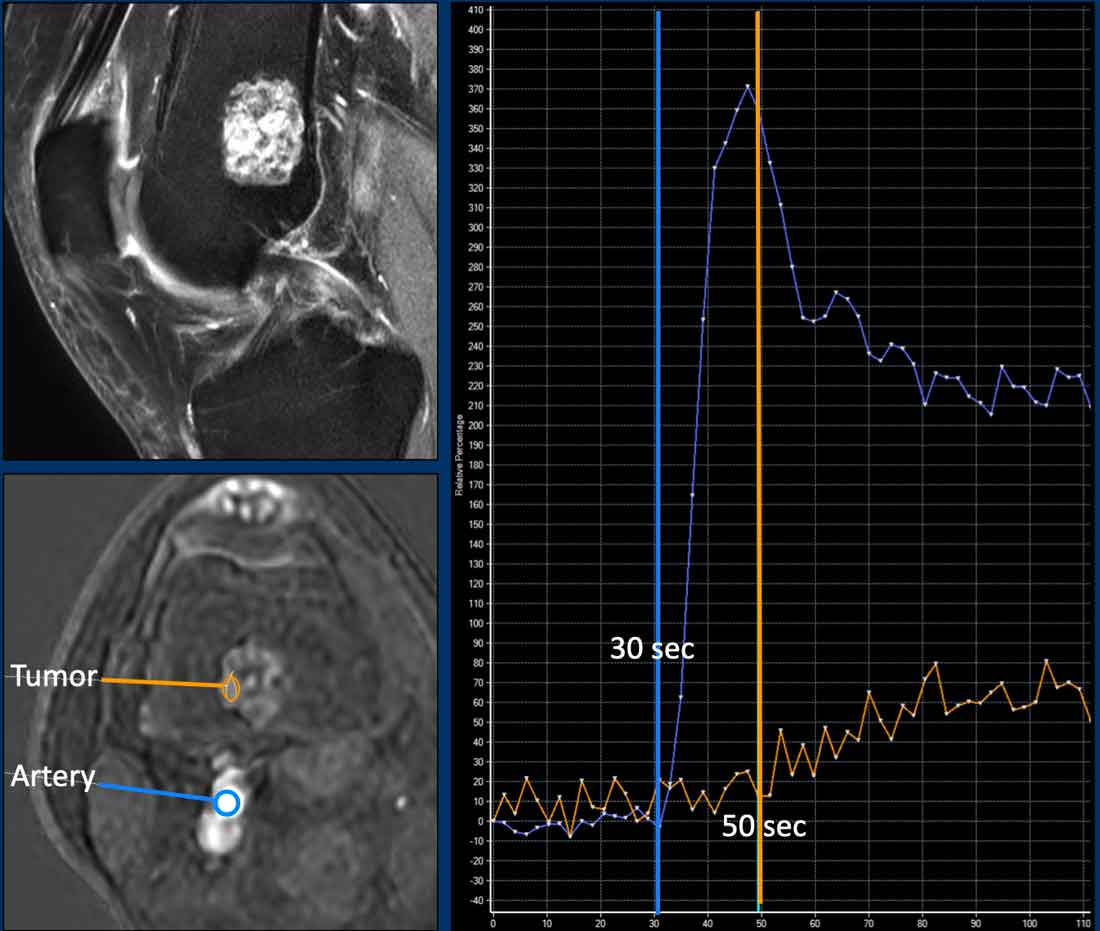 ACT along the posterior cortex in the distal femur showing septonodular enhancement after contrast.  Two ROIs were placed, one in the tumor (orange) and one in the popliteal artery (blue).