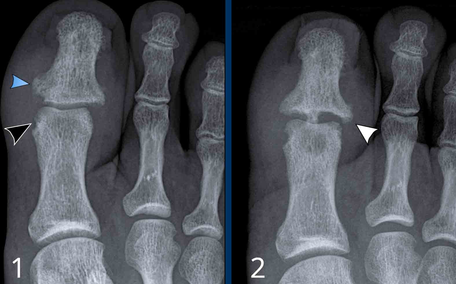 Psoriatic arthritis