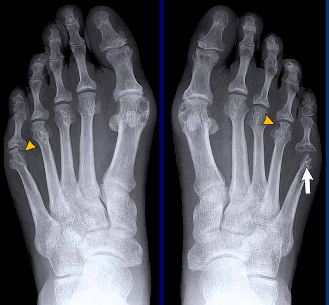 Rheumatoid arthritis in the feet