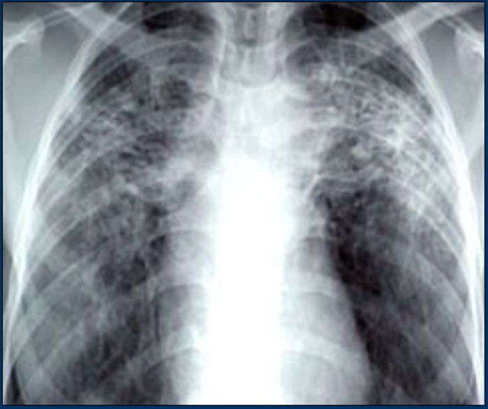 Sarcoidosis with fibrosis in the upper lobes. Typical chest film.