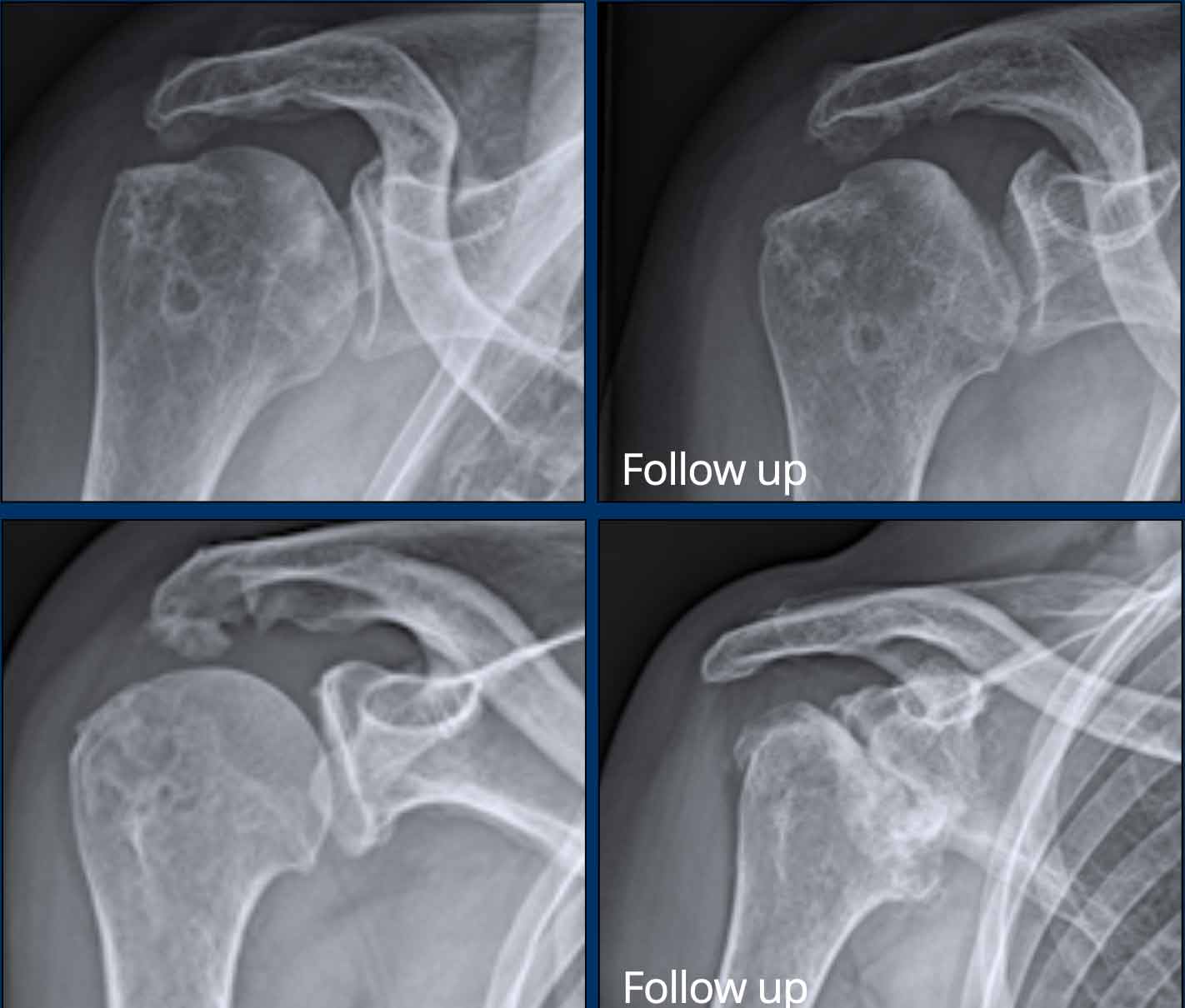 Avascular necrosis of the humeral head