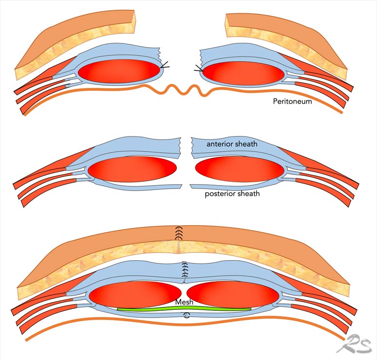 Retrorectus repair