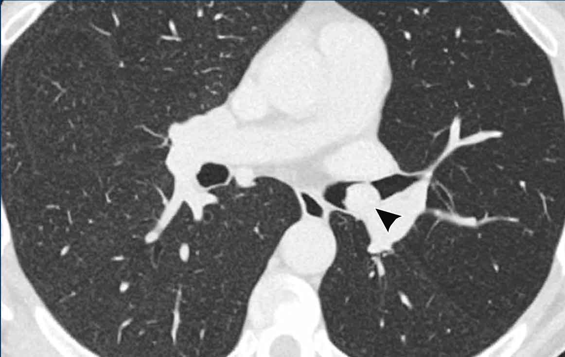 Carcinoid  in the left main bronchus