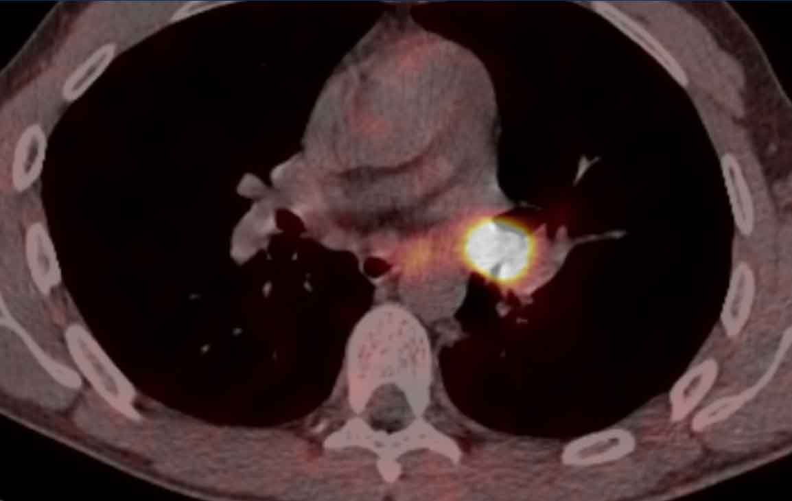 High uptake on PET-CT confirming the neuroendocrine cell origin