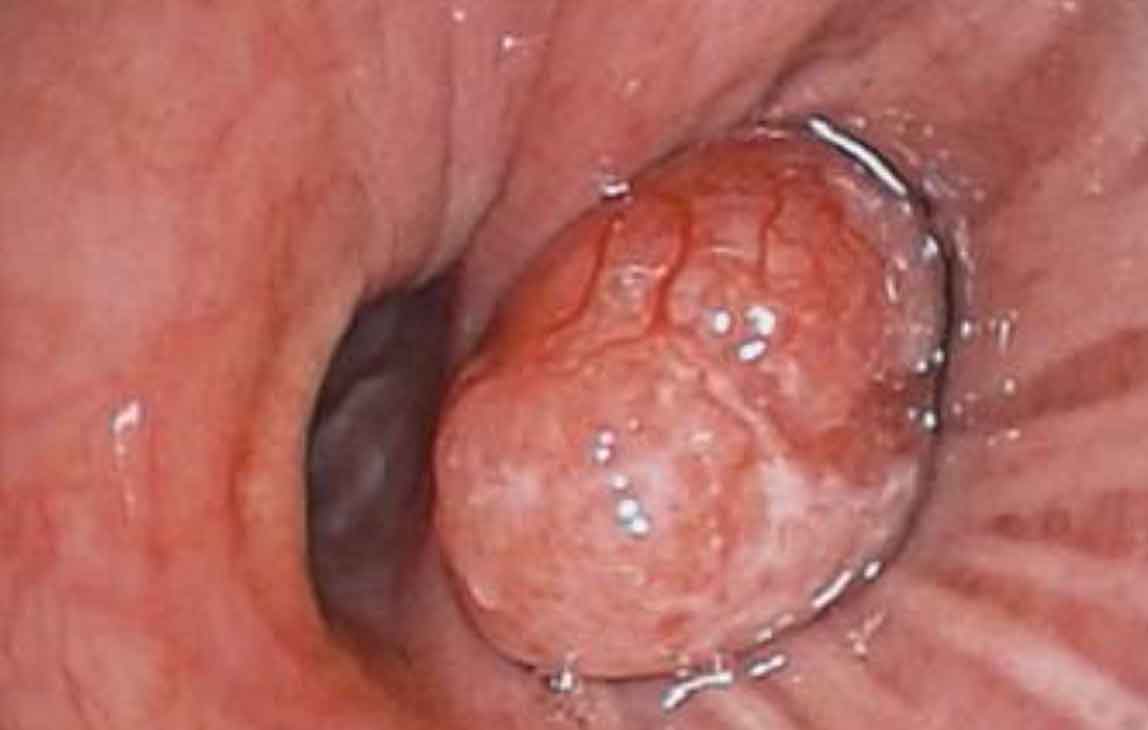 Bronchoscopic view of carcinoid