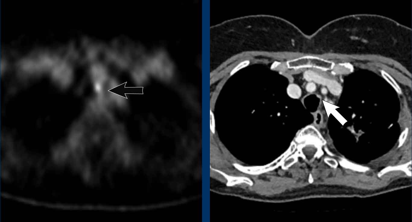 Metastasis of colorectal cancer