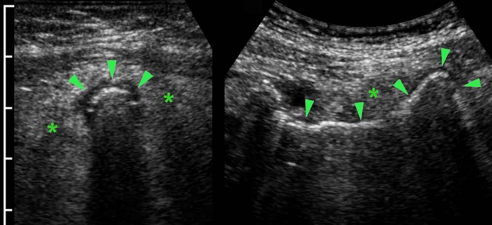 Appendicitis with air in the lumen