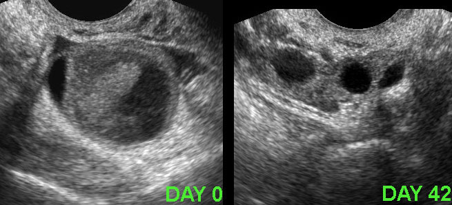 Persistent haemorrhagic cyst.