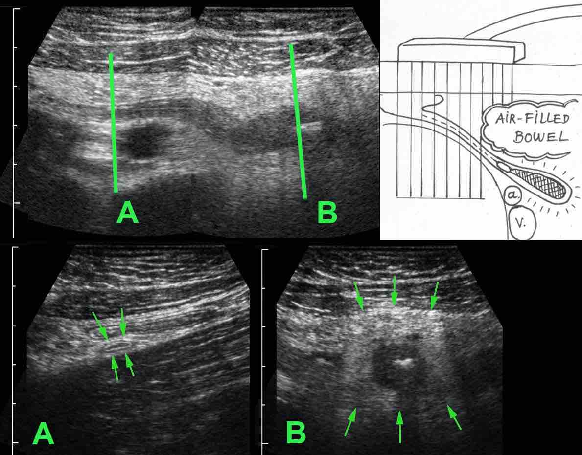 Tip appendicitis. a and v = iliac artery and vein