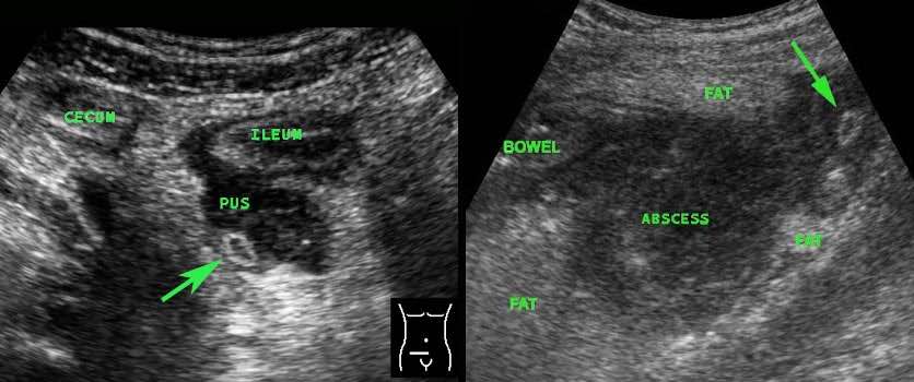 Perforated appendix with normal diameter