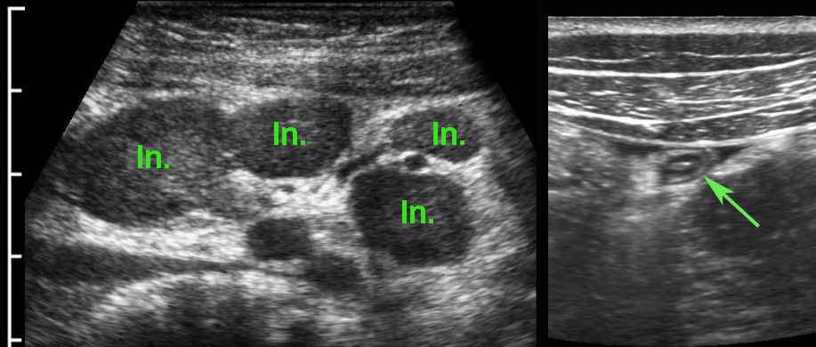 Mesenteric lymphadenitis