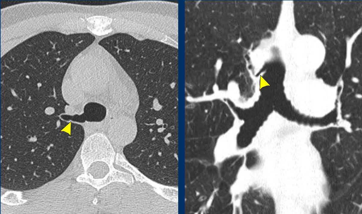 Two examples of a tracheal bronchus